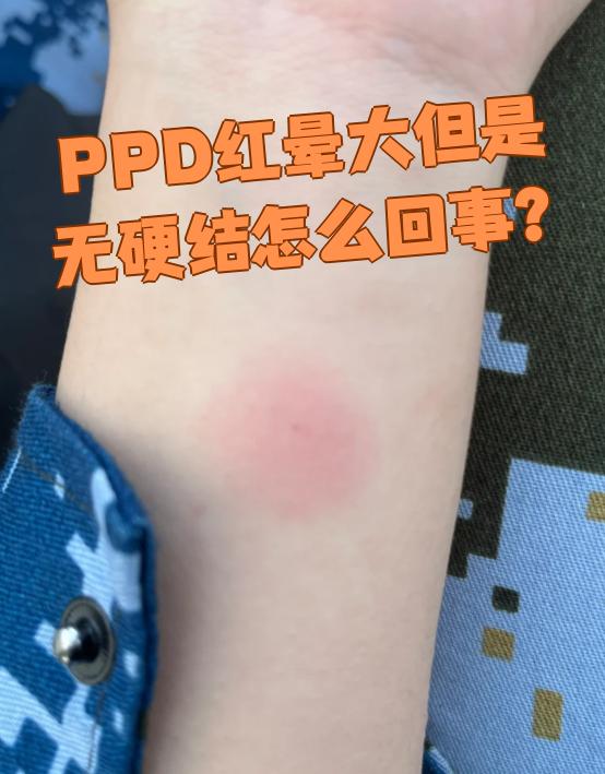 ppd红晕大但无硬结是结核菌素试验后的常见现象,这种情况通常说明