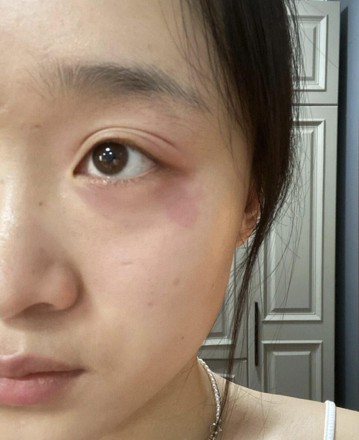 过敏  如果用了不合适的护肤品或洗漱用品,可能会刺激眼周皮肤,引起