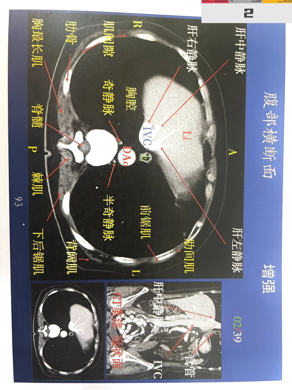 腹部第一组增强解剖!肝脏ct增强解剖!上腹部 肝脏详细横断面解剖图!