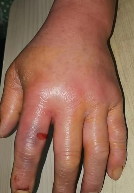 急性炎症时组织肿胀的主要原因是液体渗出和血管扩张