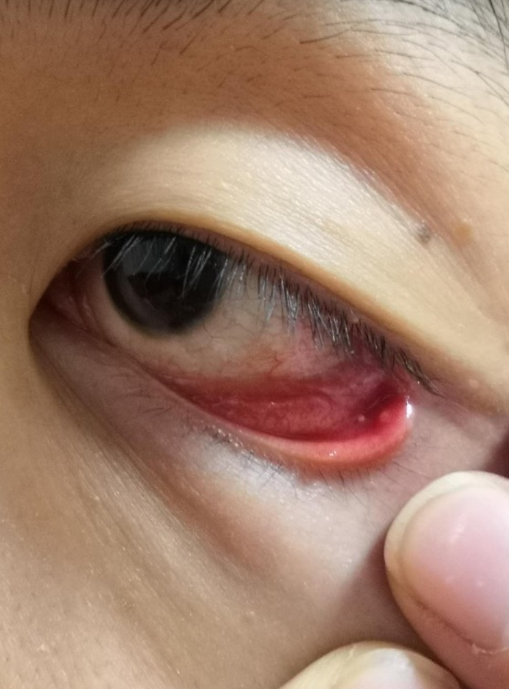 怎么办?  眼睑长小水泡磨眼睛,常见原因有睑板腺管堵塞,过敏或睑腺炎