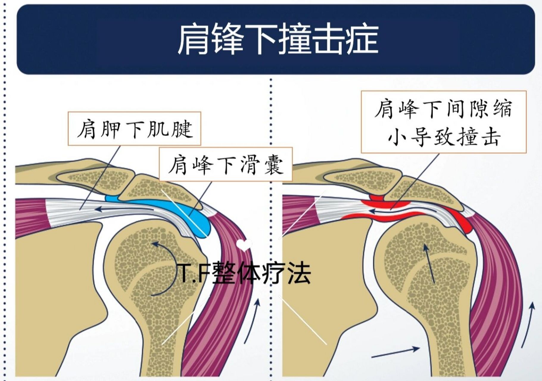 肩峰在哪个位置图图片