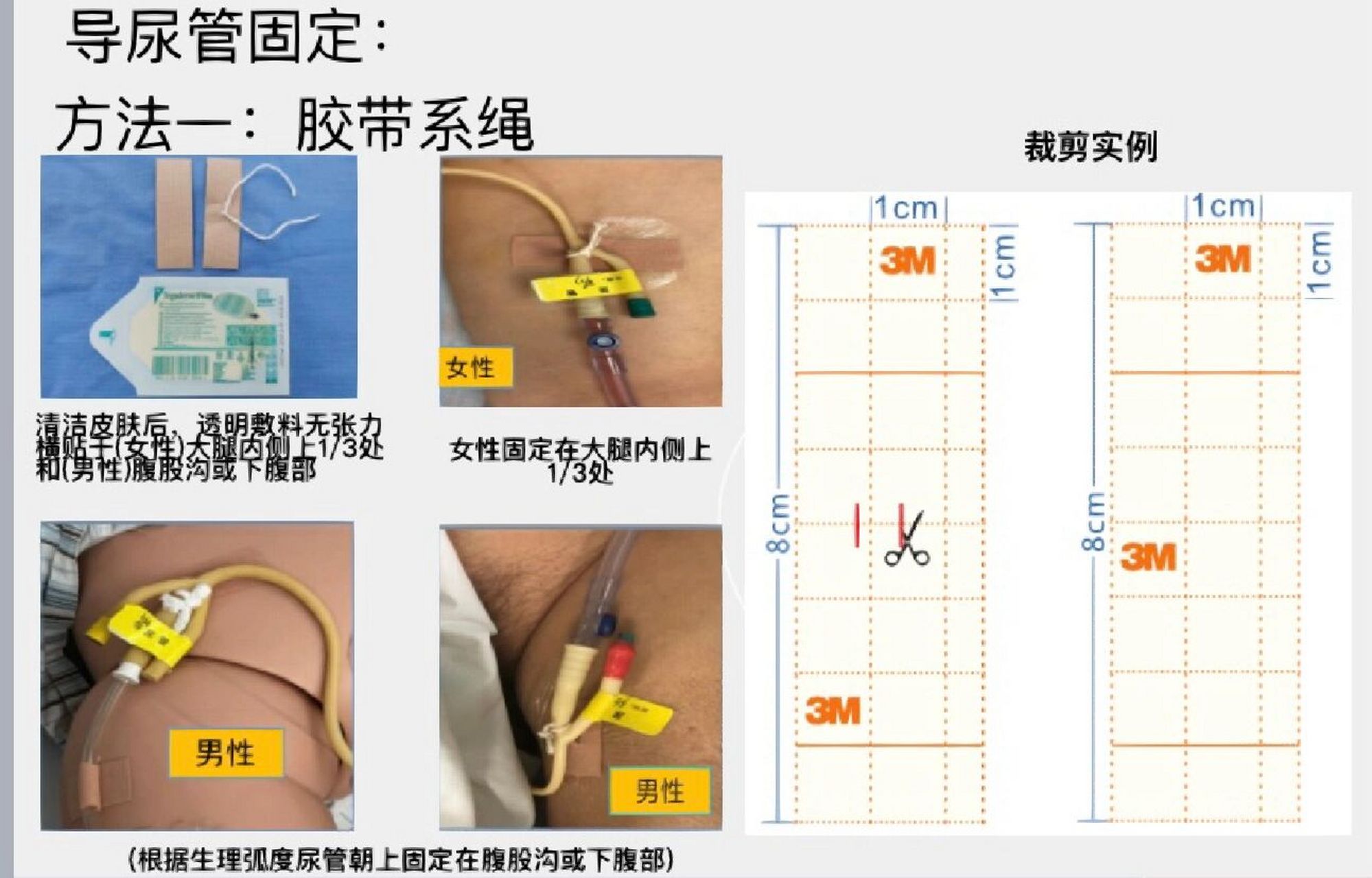 导管固定篇2之导尿管图文固定           每天2节普拉提差点把自己累