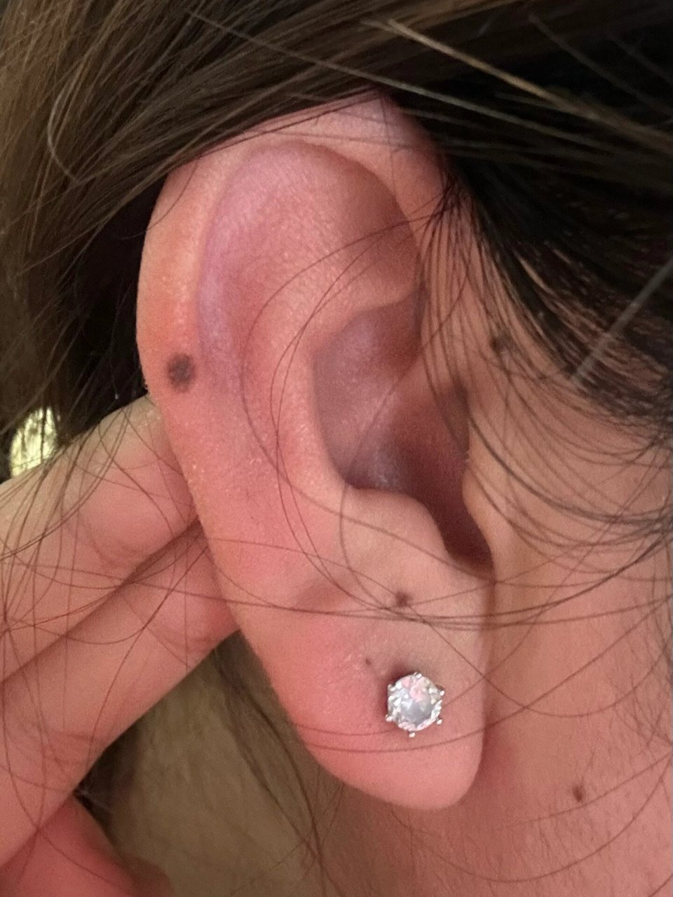 耳朵上突然长了痣 今天突然发现耳朵上多了几个痣 怎么回事