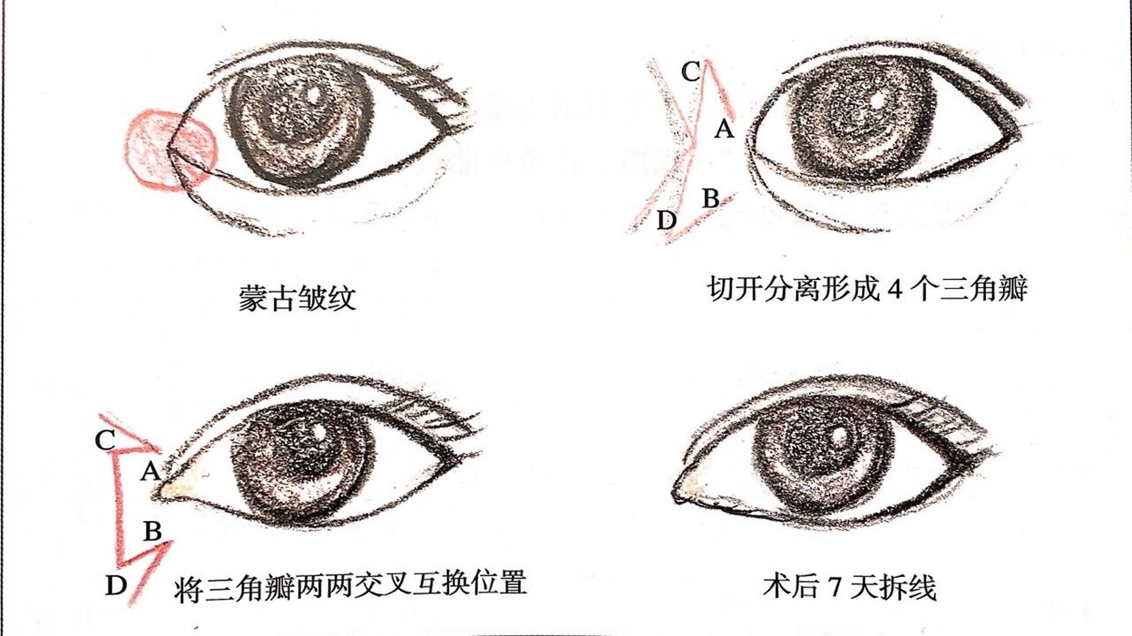 开内眼角不同形状图片图片