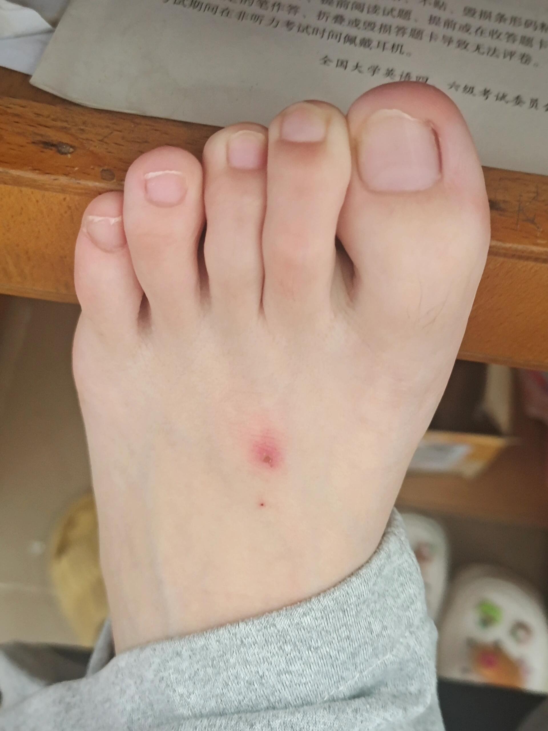 被蜘蛛咬了会死吗