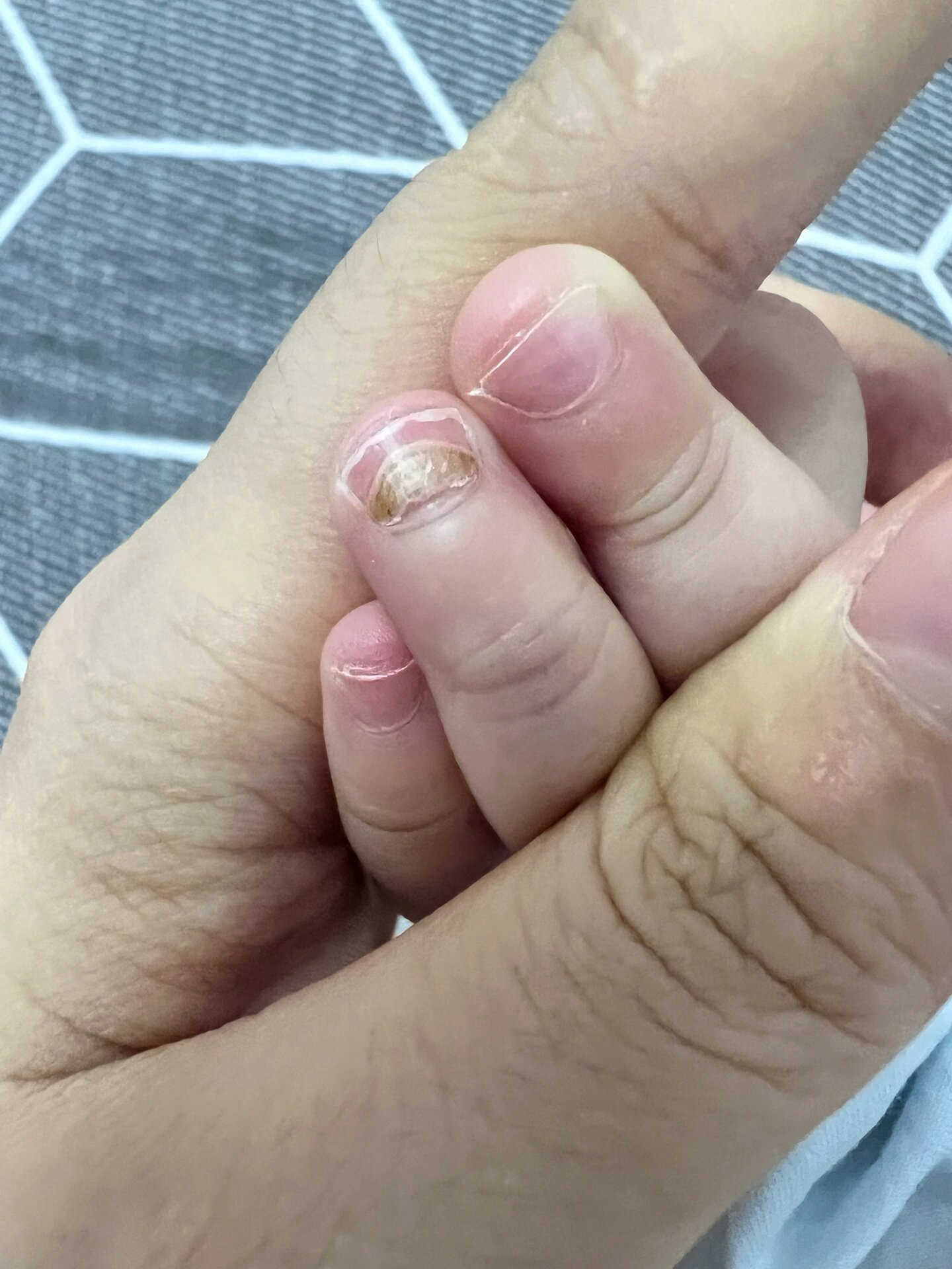 宝宝指甲脱落