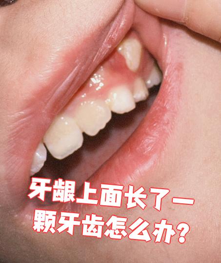 牙龈上面长了一颗牙齿,可能是牙齿移位,畸形发育,融合牙,额外羊或