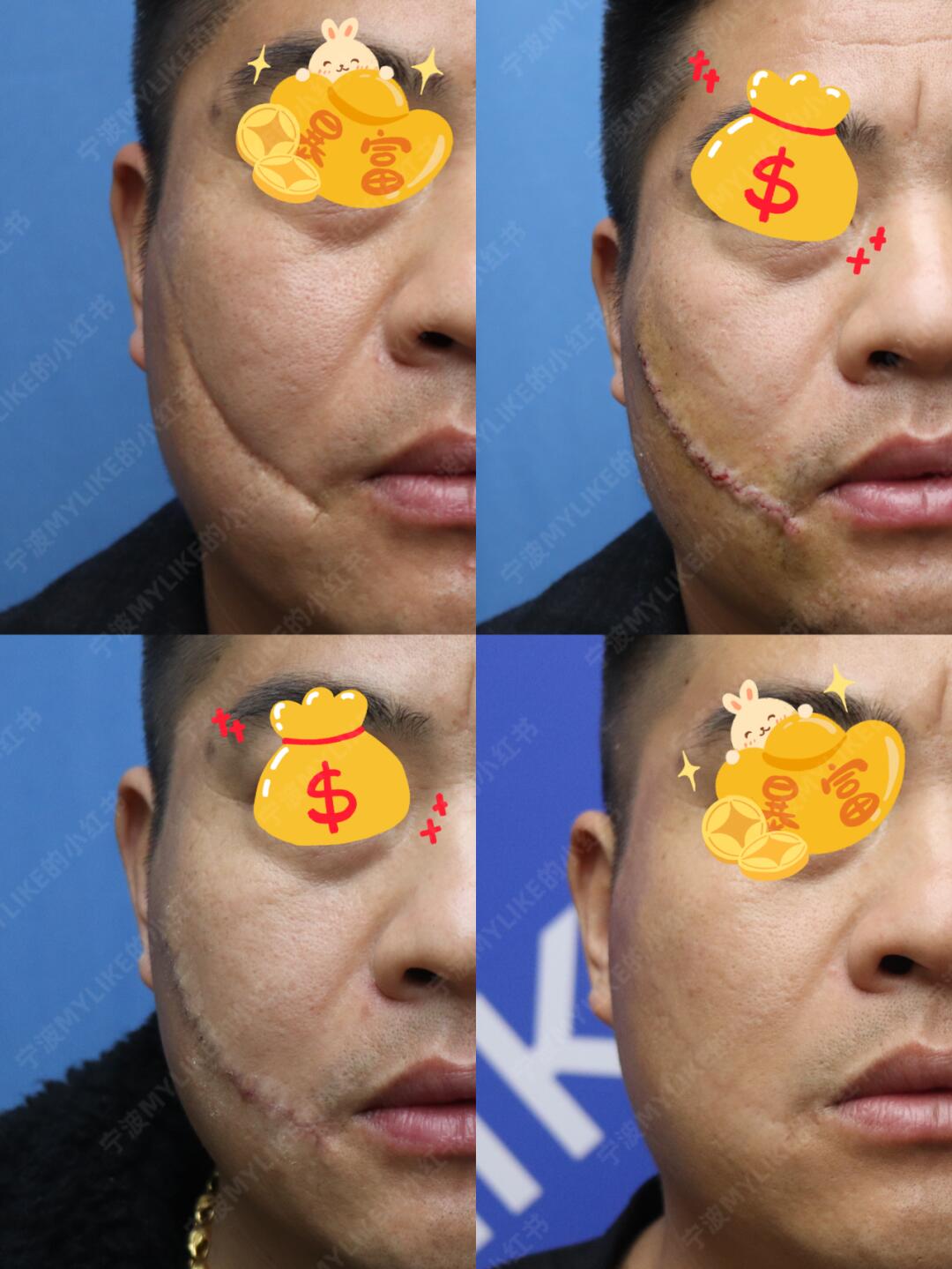 面部凹陷疤痕修复,细节大公开!