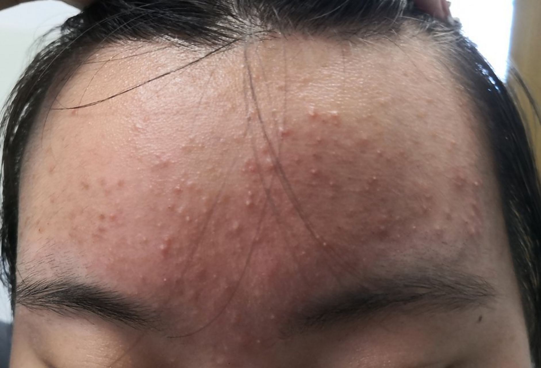 额头面颊炎症性丘疹红斑脓疱症状.是常见的痤疮发病部位和症状.