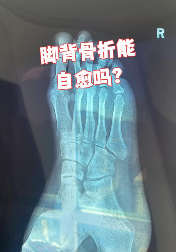 脚背骨折能不能自己长好,得先去医院拍x光片看看骨折的具体情况