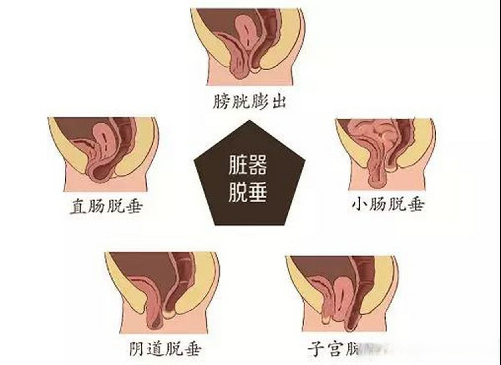 女性健康#盆底功能障碍 当盆腔肌肉和韧带失去张力时,盆底脏器就