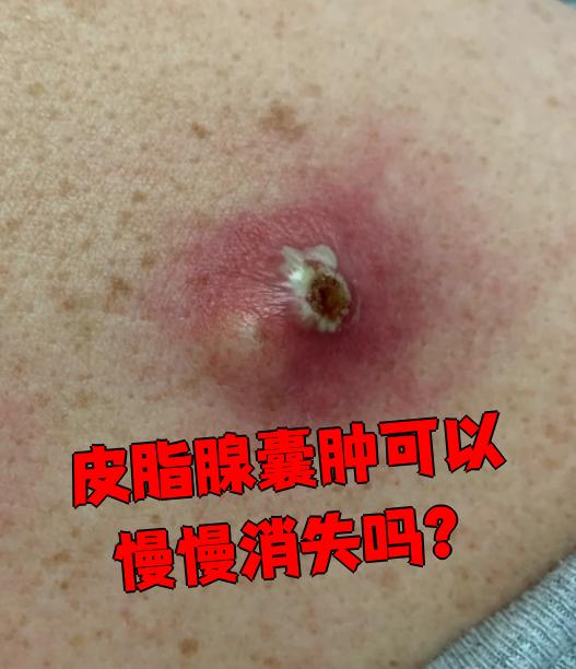 皮脂腺囊肿通常不会自己慢慢消失