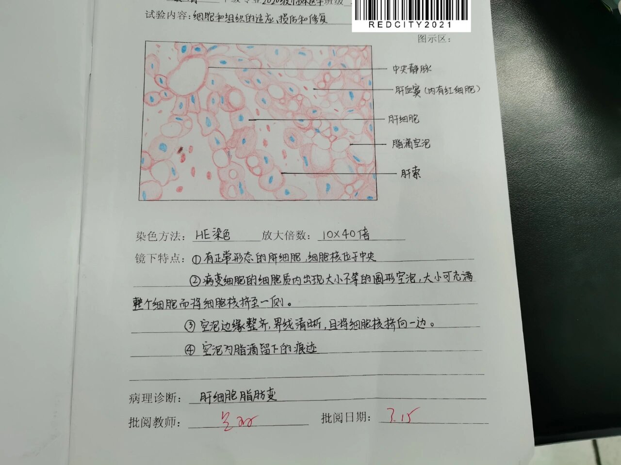 病理实验报告——肝细胞脂肪变