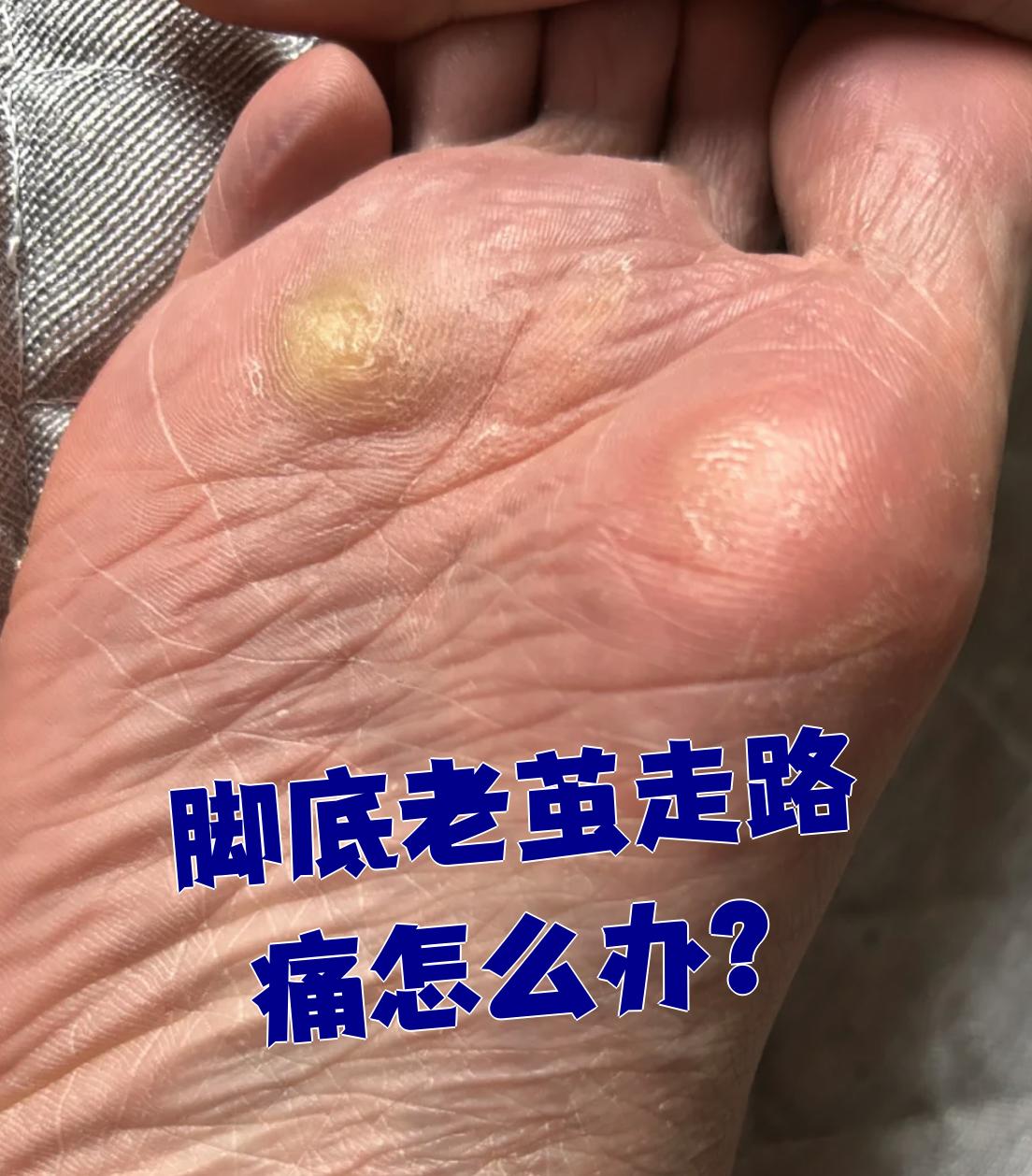 脚底老茧走路疼痛,通常和鞋子太紧或者长了胼胝有关