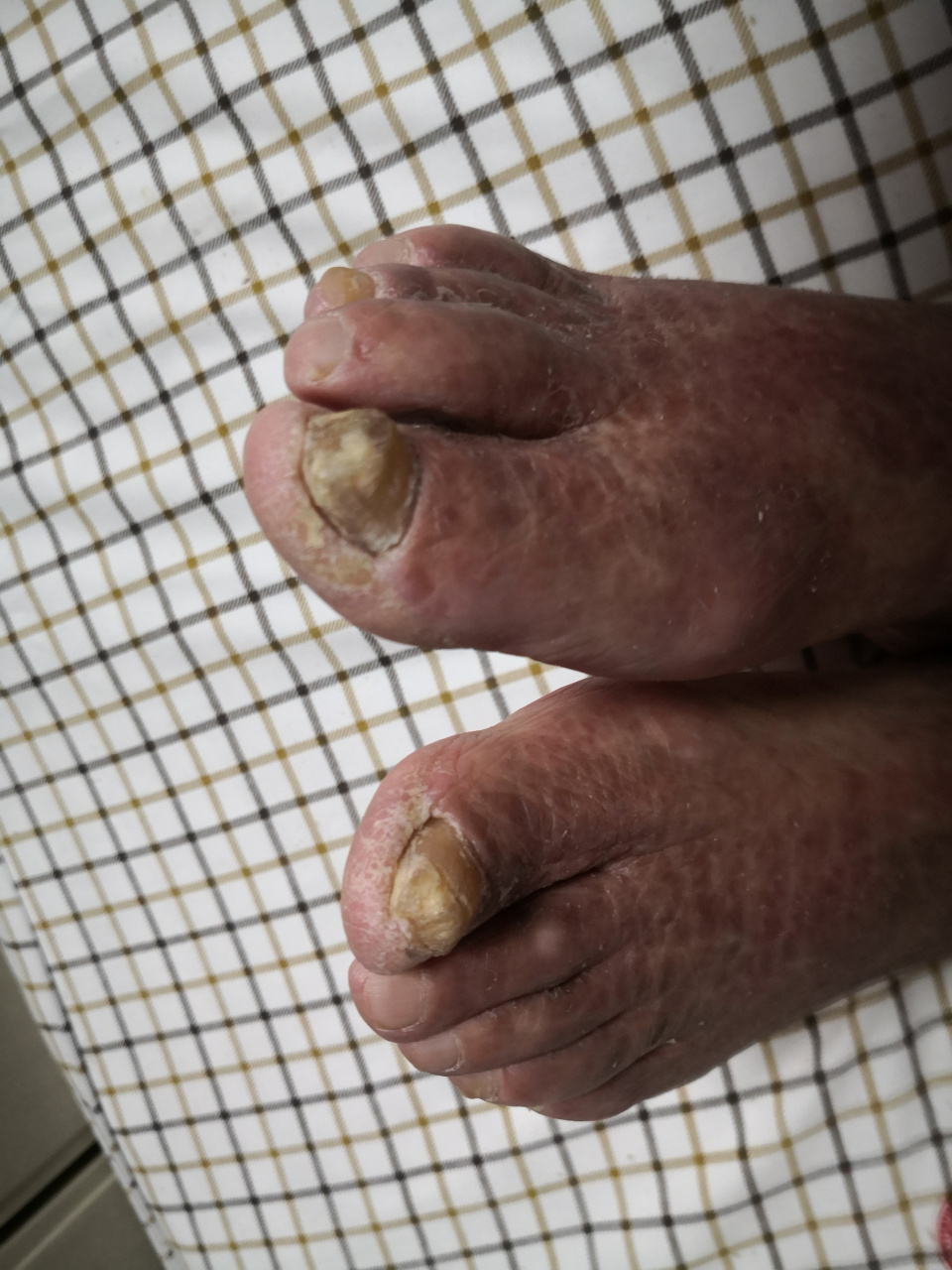 药物引起的暗红色斑片.考虑药物过敏反应#药疹##解决皮肤问题专注皮肤