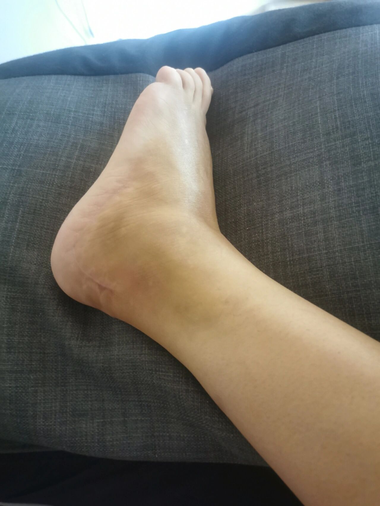 左脚跟骨骨折术后56天,期待早日能下地走路