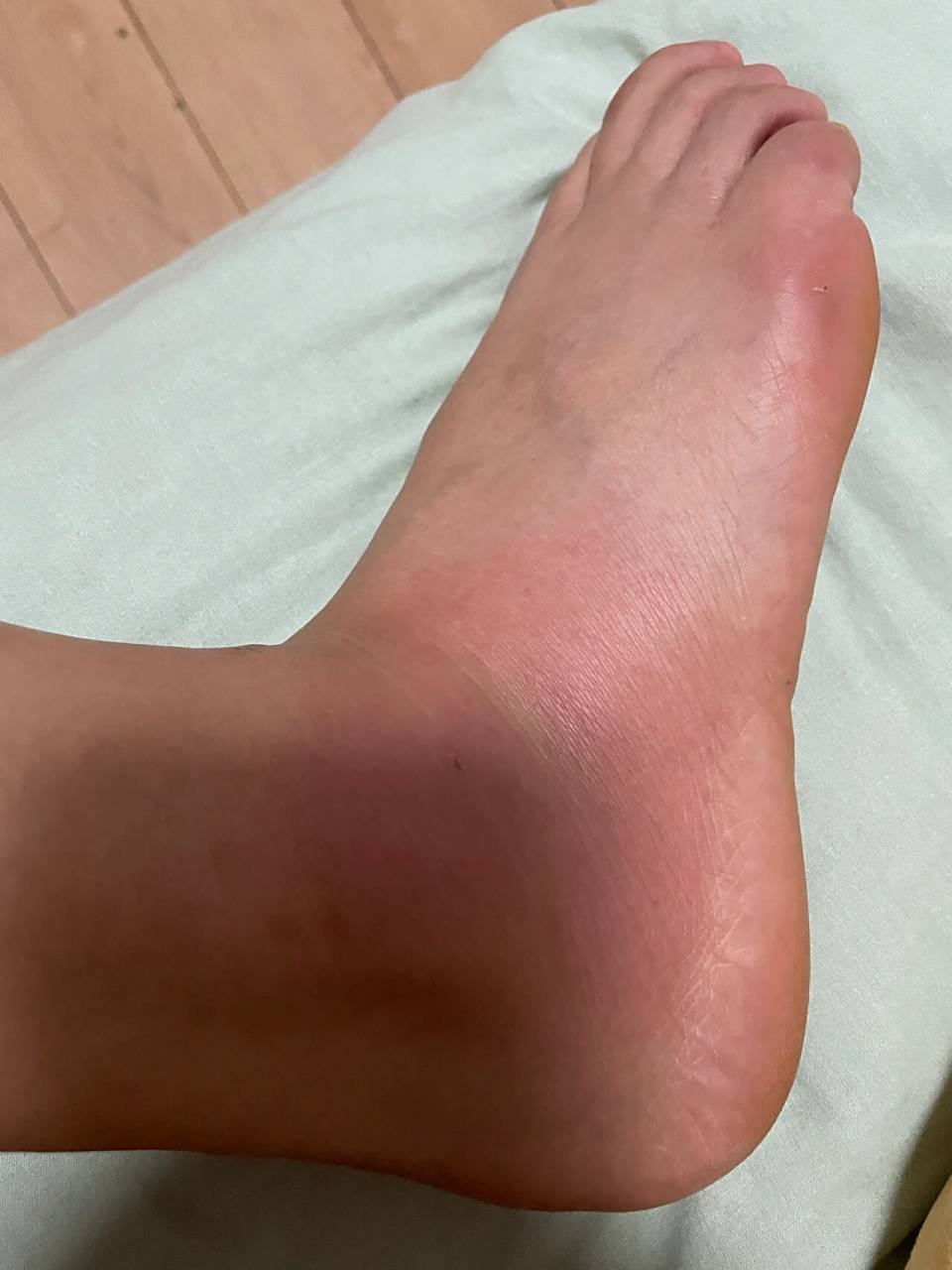 谁能告诉我,为什么蚊子咬后整个脚踝都肿了