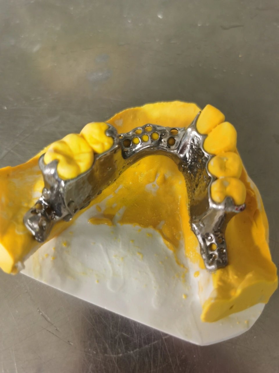 纯钛支架活动义齿 局部缺失是这样的,你也可以选择种植牙哦,,,#牙齿