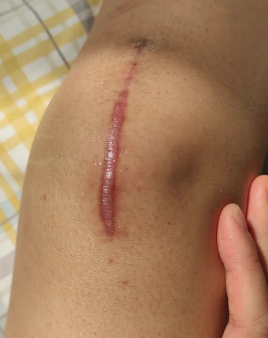 侧切伤口疤痕凸起来怎么祛除?