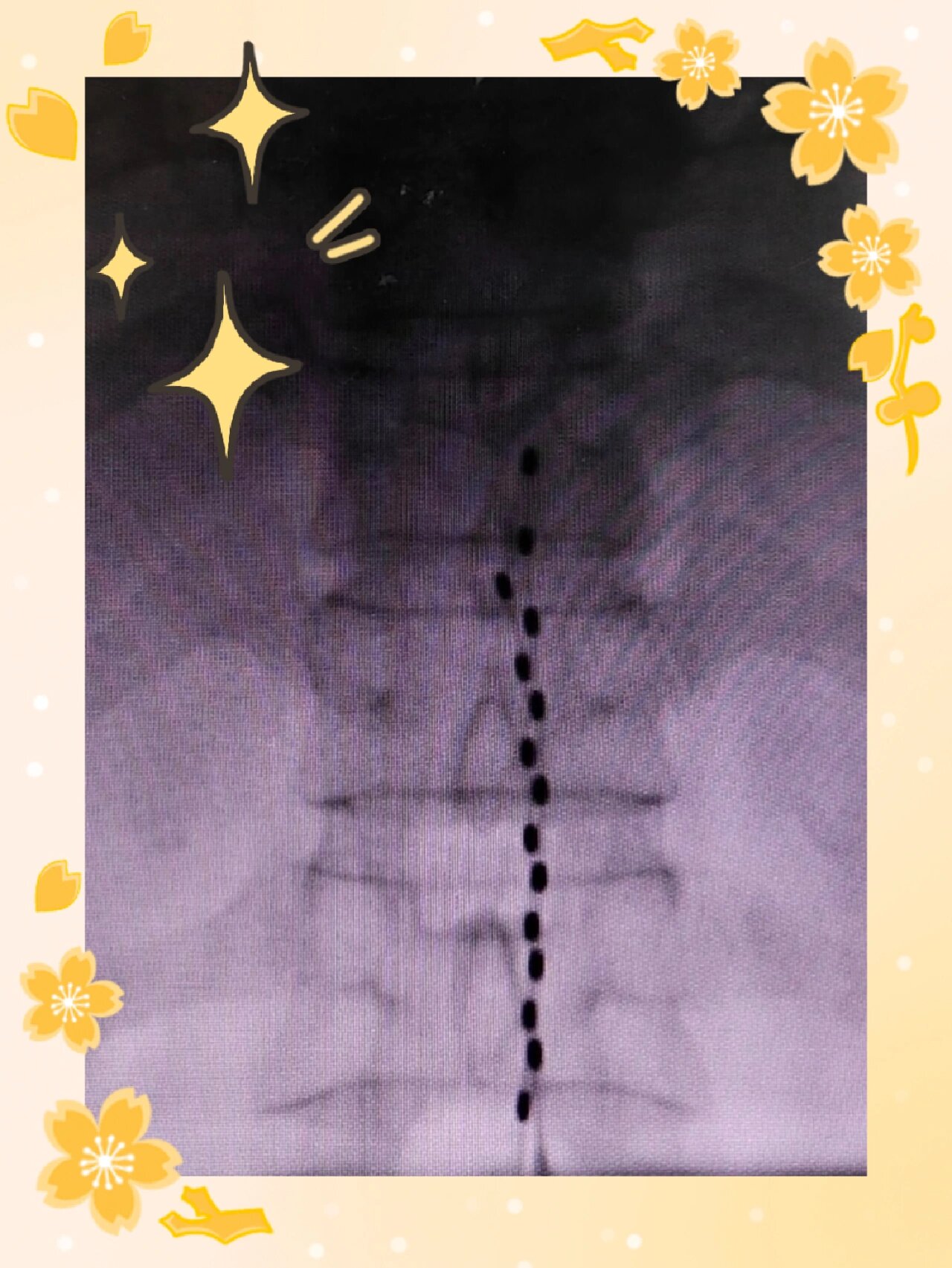 脊髓电刺激是个啥?能治哪些病?