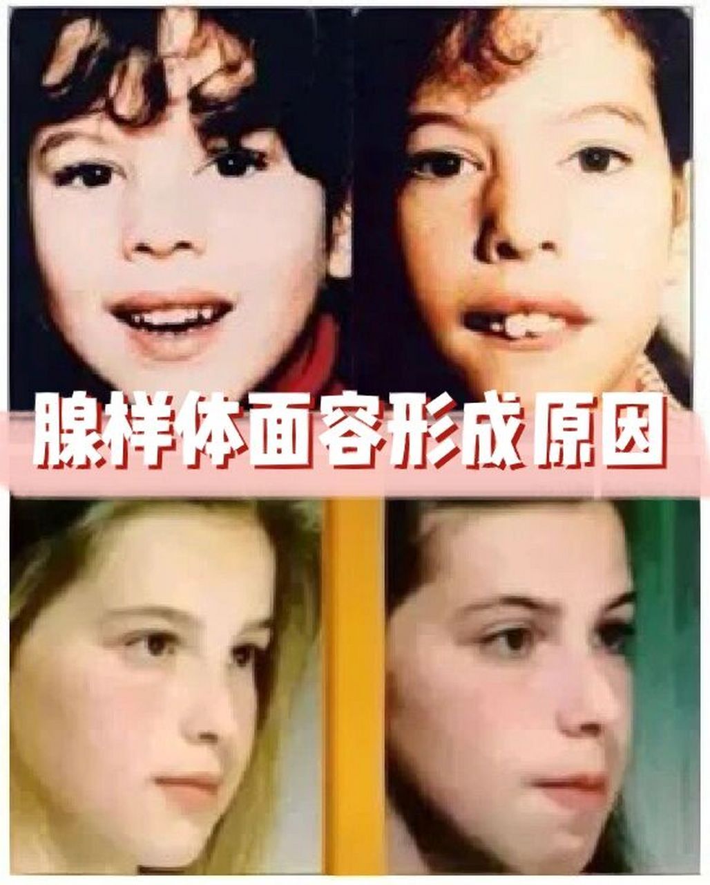 很多妈妈一定很关心孩子的腺样体面容是怎样形成的.