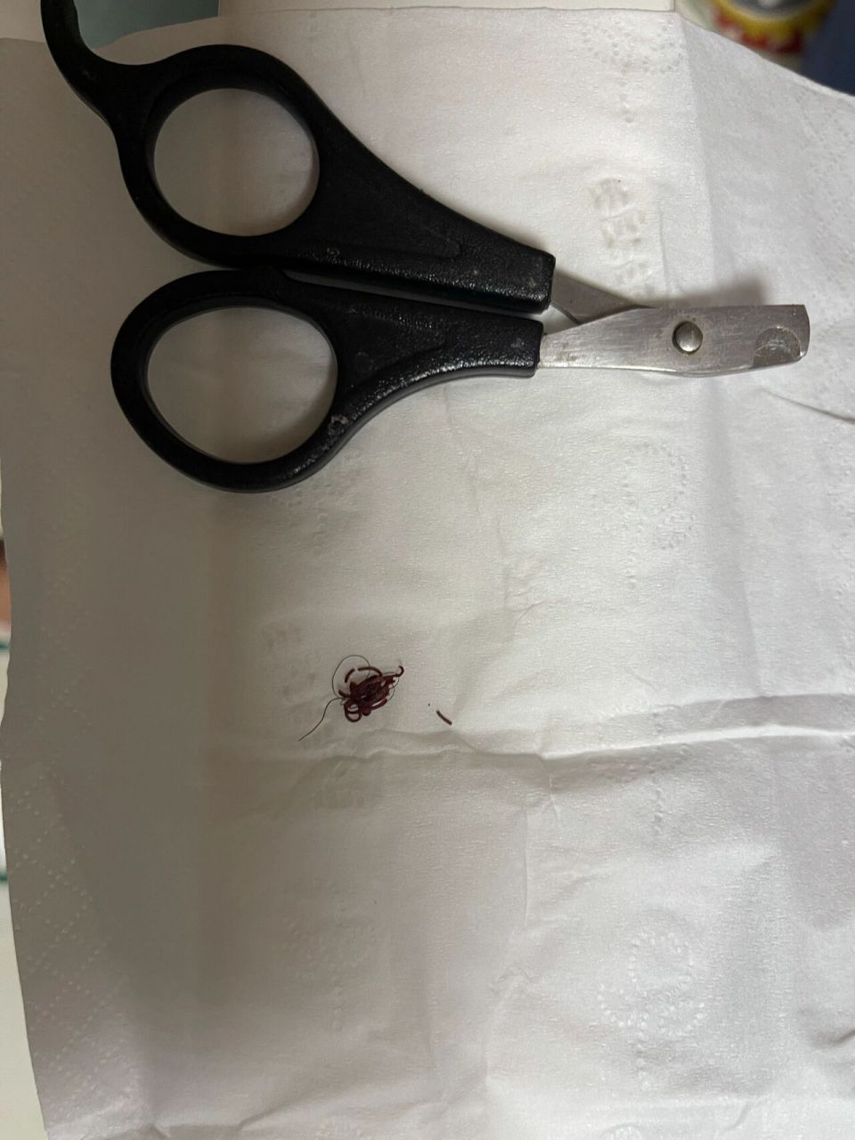 产后42天 缝合线不吸收 26天的时候去医院,大夫说伤口太大不给拆线.