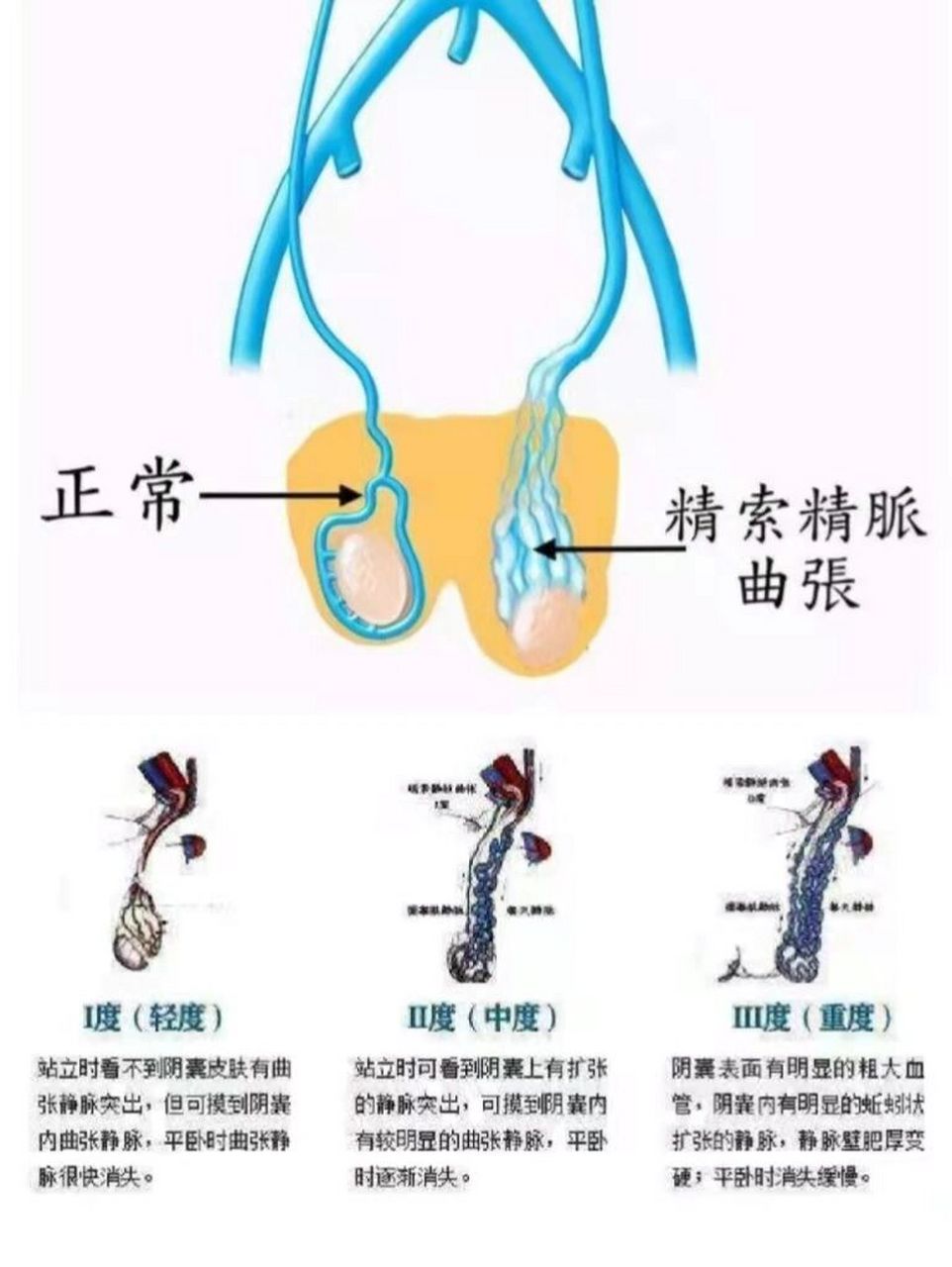 "蛋蛋"的忧伤——精索静脉曲张 🤷‍♂️什么是精索静脉曲张? 