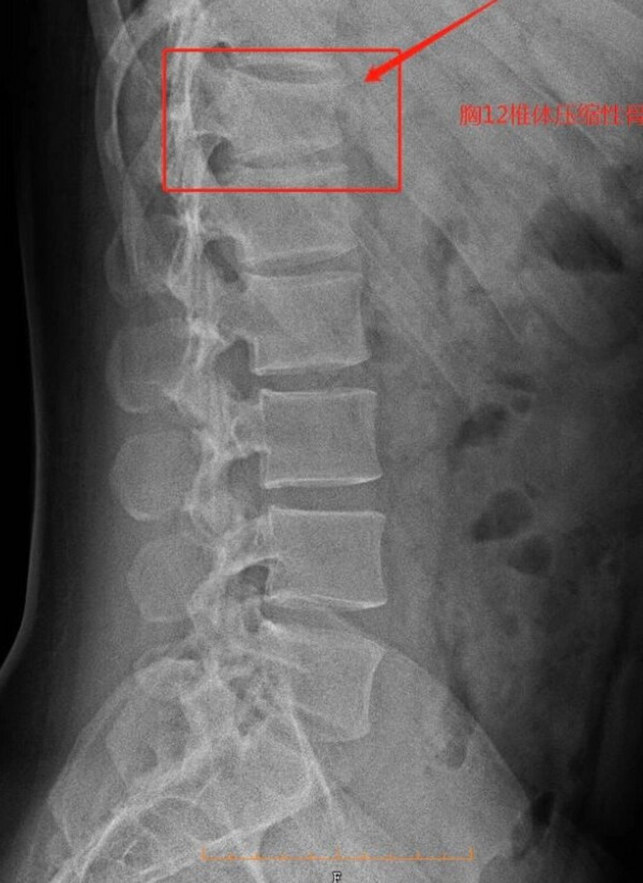 胸十二椎位置图片