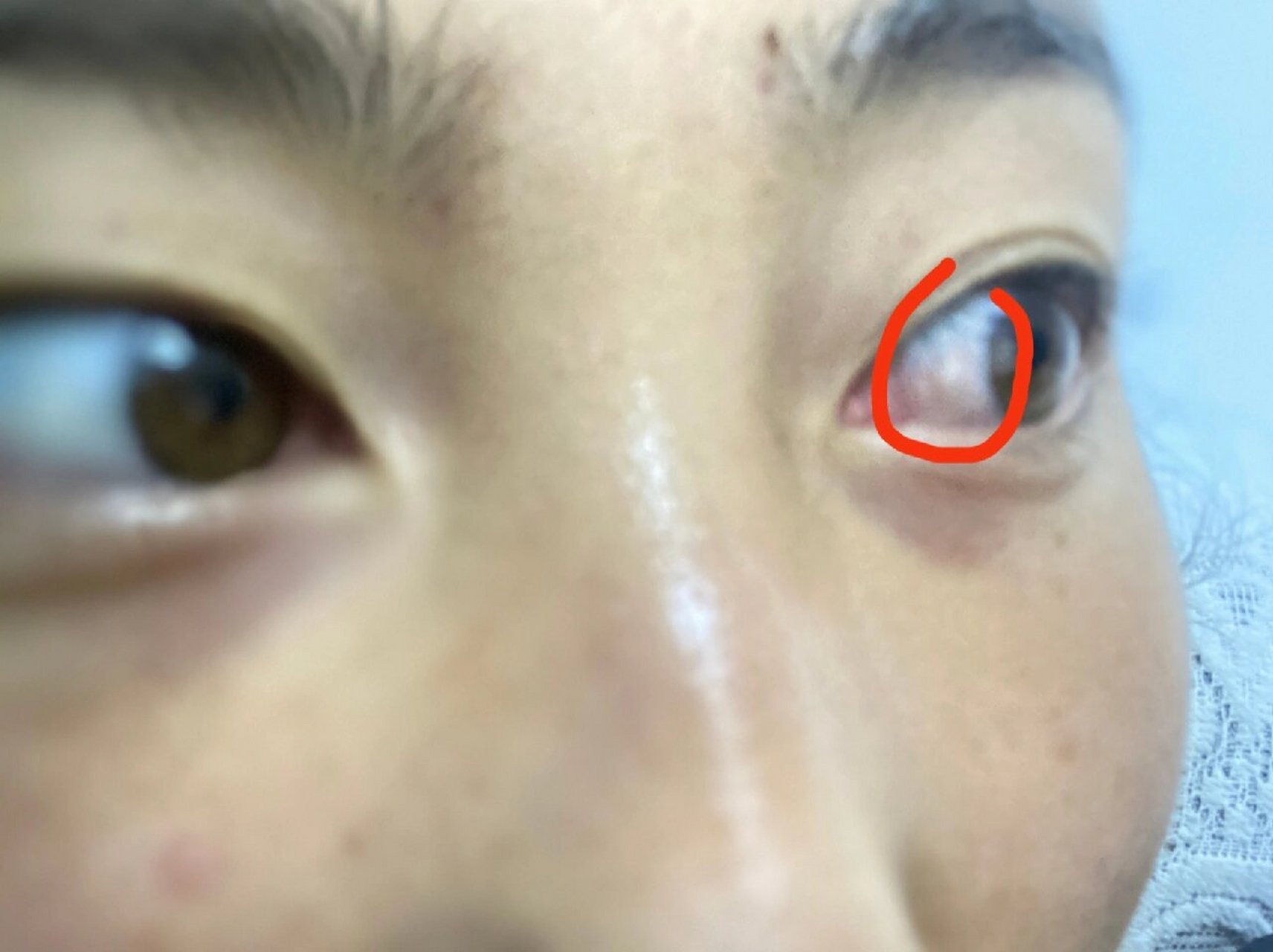 谁知道白眼球上的白点是什么啊