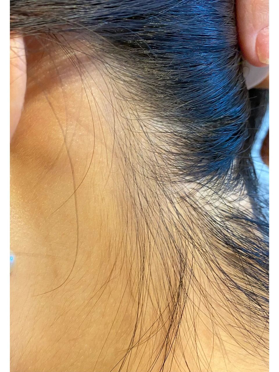 耳朵后面长鼓包 耳朵后面同样的位置几个月前长过一次鼓包,长了两个