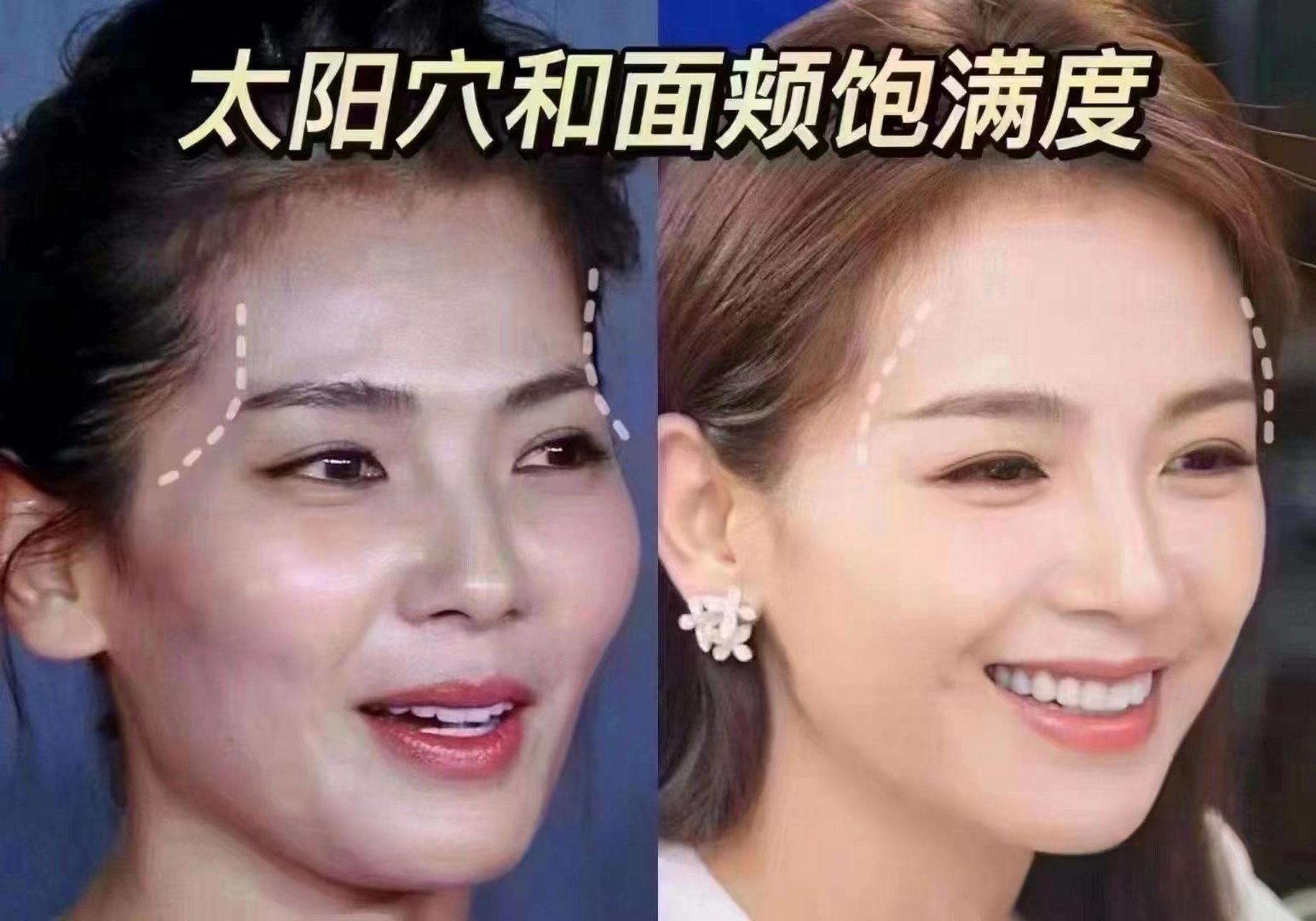 太阳穴也叫"夫妻宫" 太阳穴也叫"夫妻宫" 这里凹陷会显得人苦相,憔悴