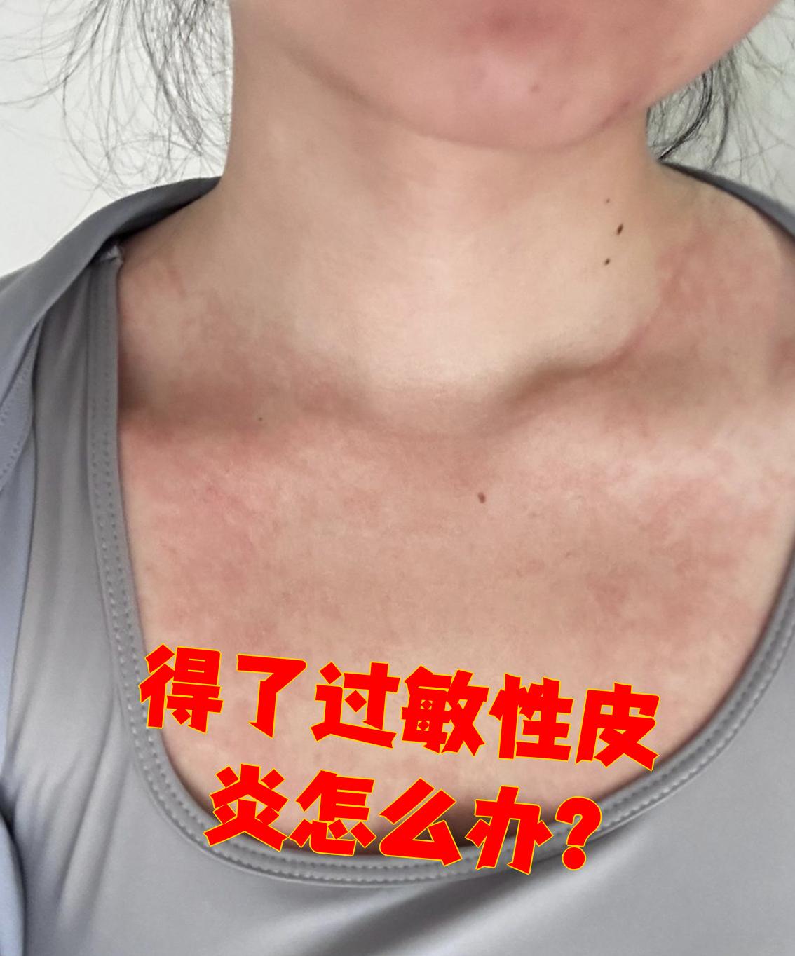 为什么会得皮炎?为什么在线 为什么会得皮炎?为什么在线