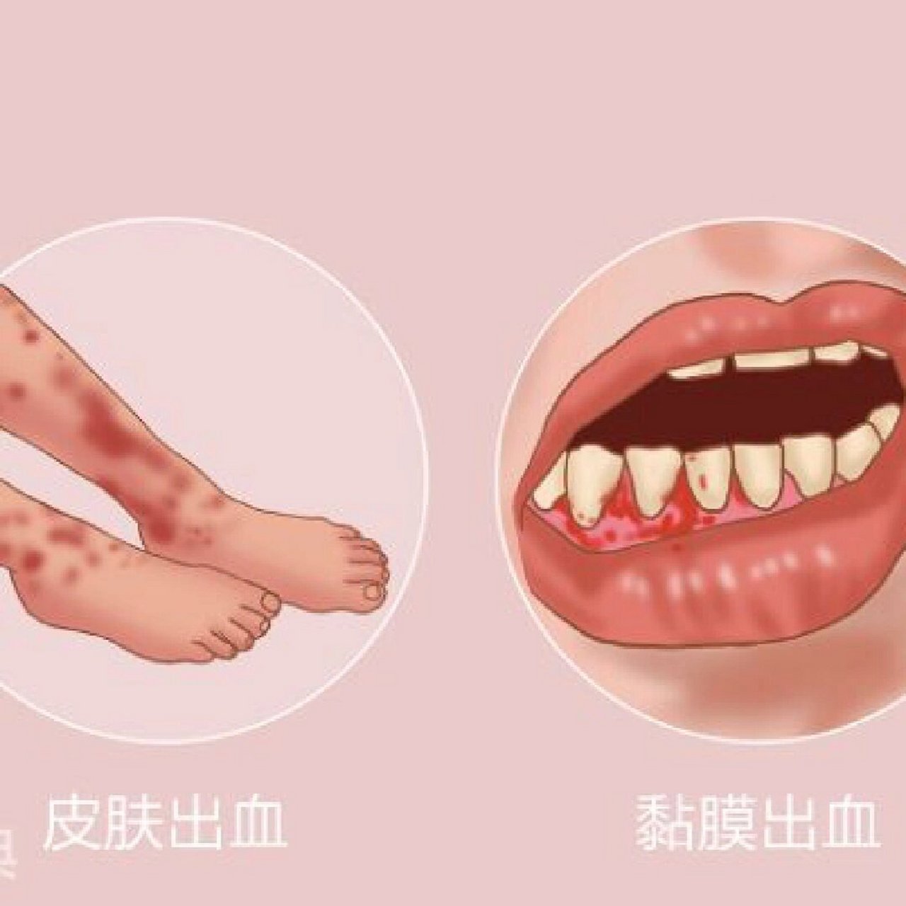 免疫性血小板减少症  临床异质性较强.