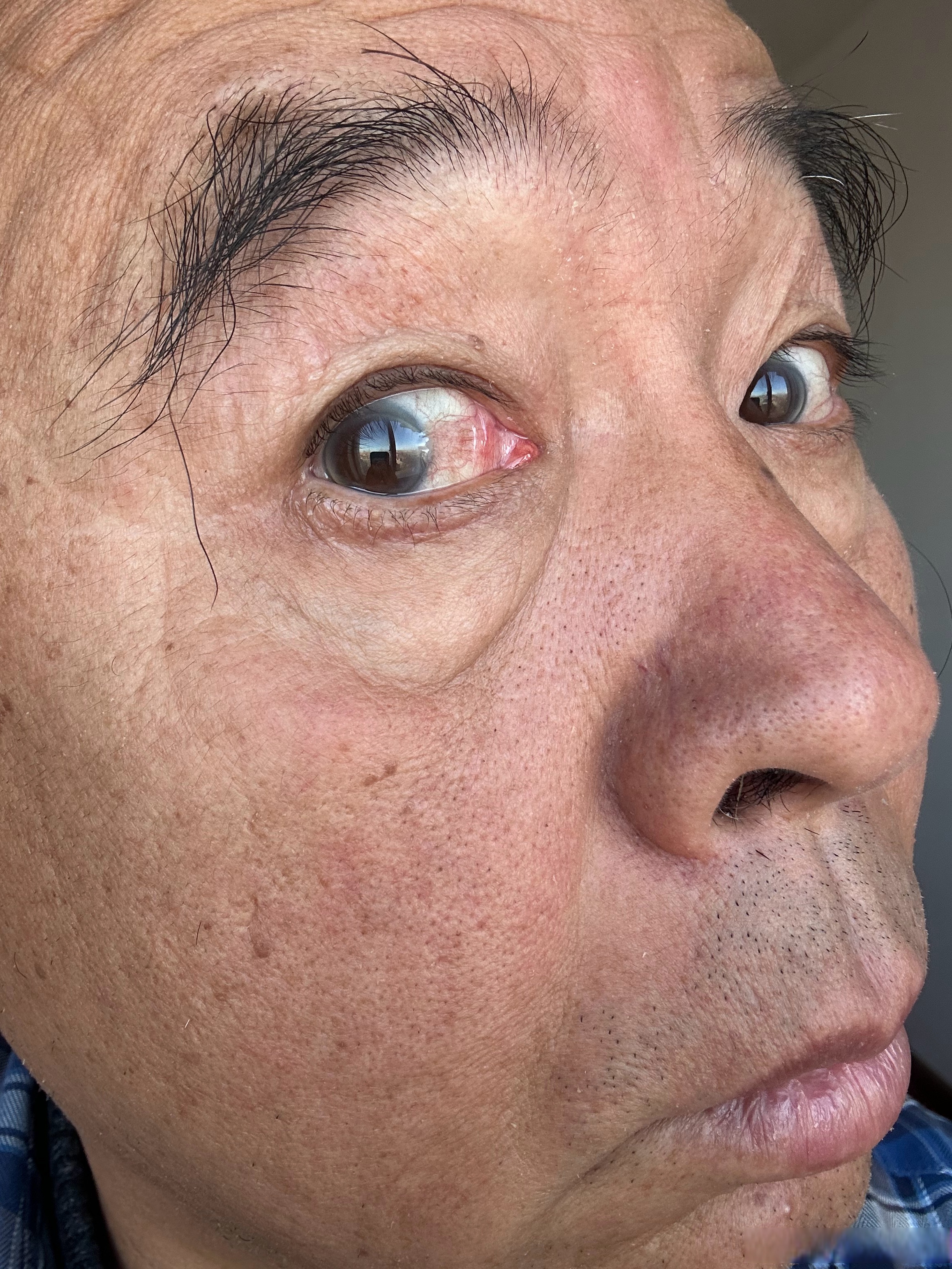 生活手记#记录右眼的变化,褶皱减小,但是黑眼仁边界