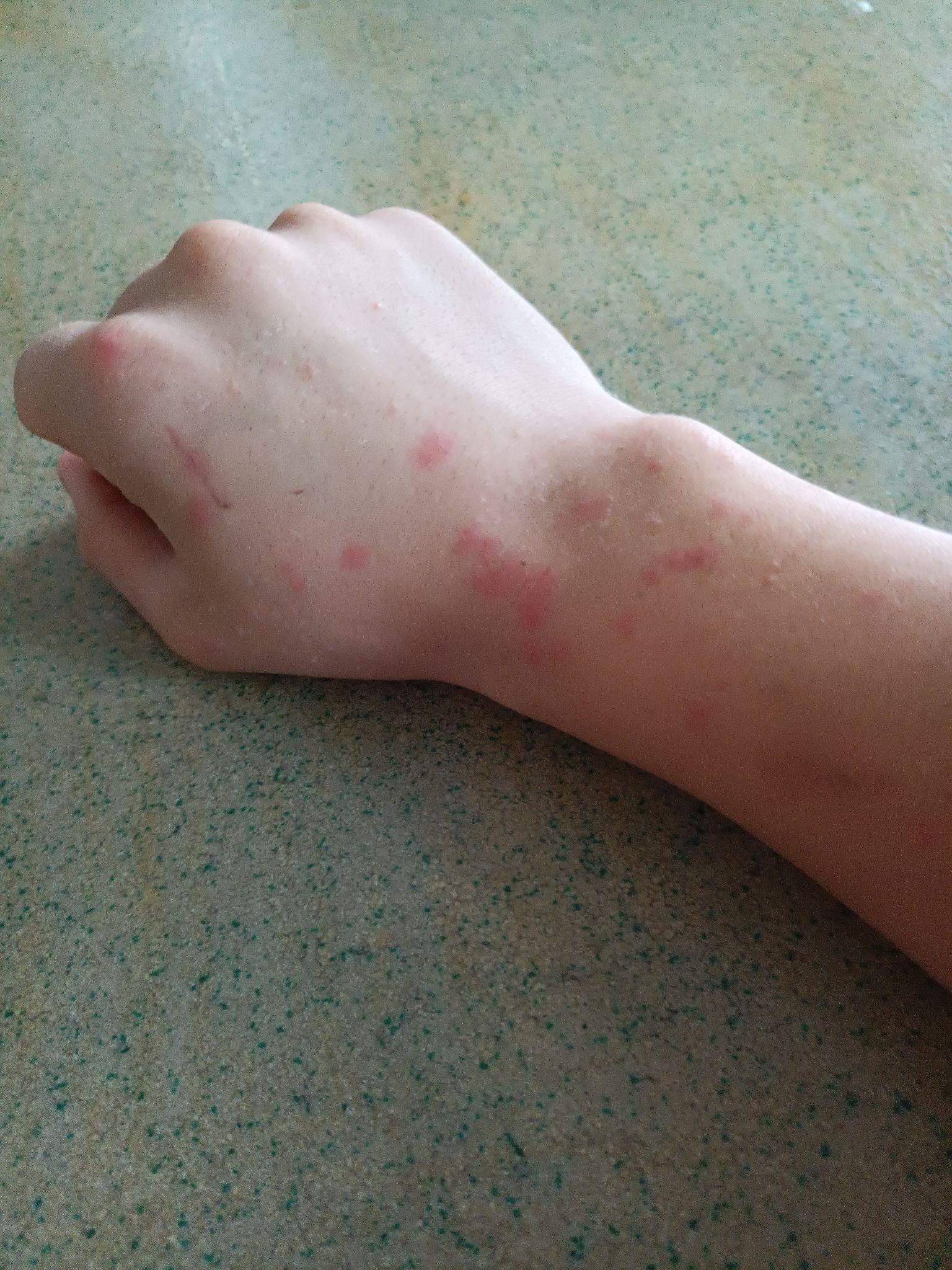 手上长这种小红斑是什么东西啊目前就右手长的多左手就一两个会有点痒