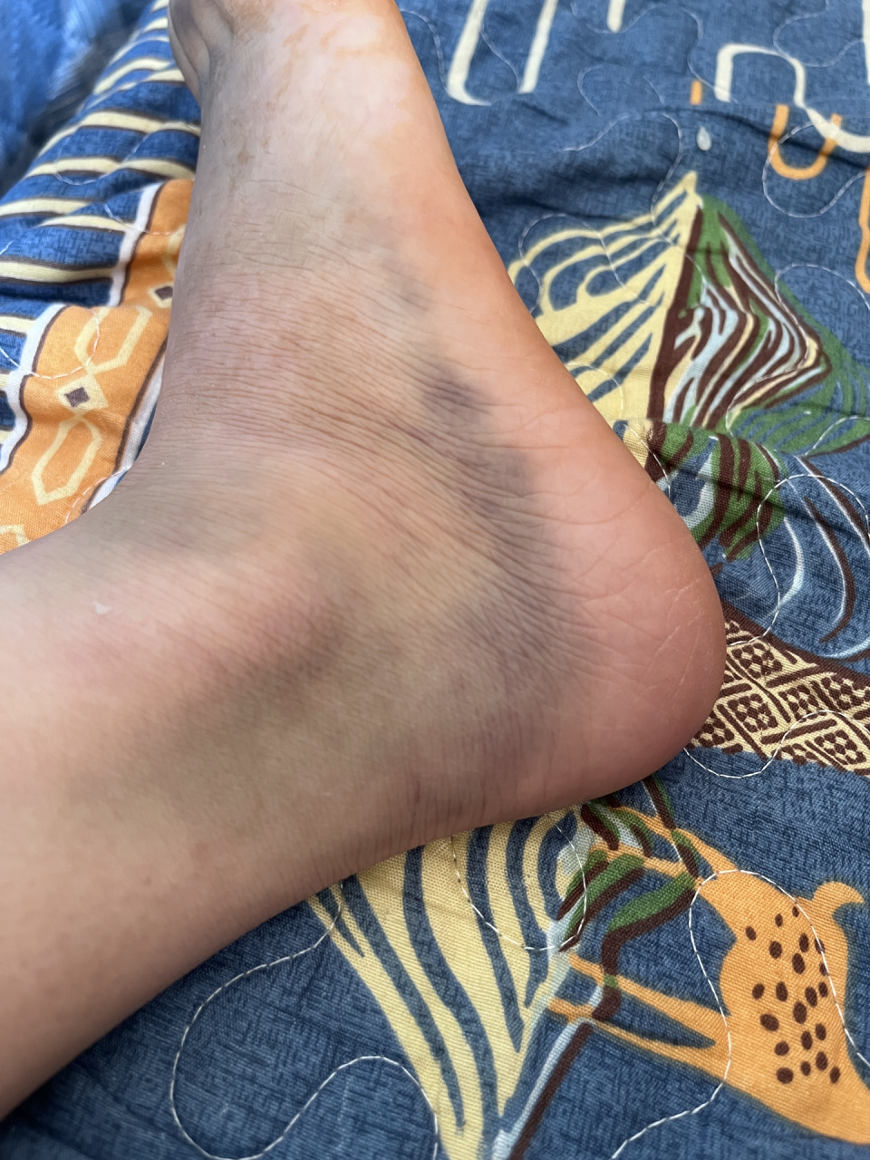 淤青,软组织损伤 小红书姐妹推荐的扶他林,对骨折以后大片的淤青,按压