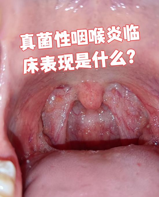 病人通常会表现出咳嗽咳痰,声音嘶哑,咽喉疼痛等症状