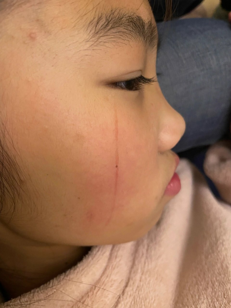 指甲划伤 求助:指甲划伤己经4个月了.是不是不会好了?怎么办?