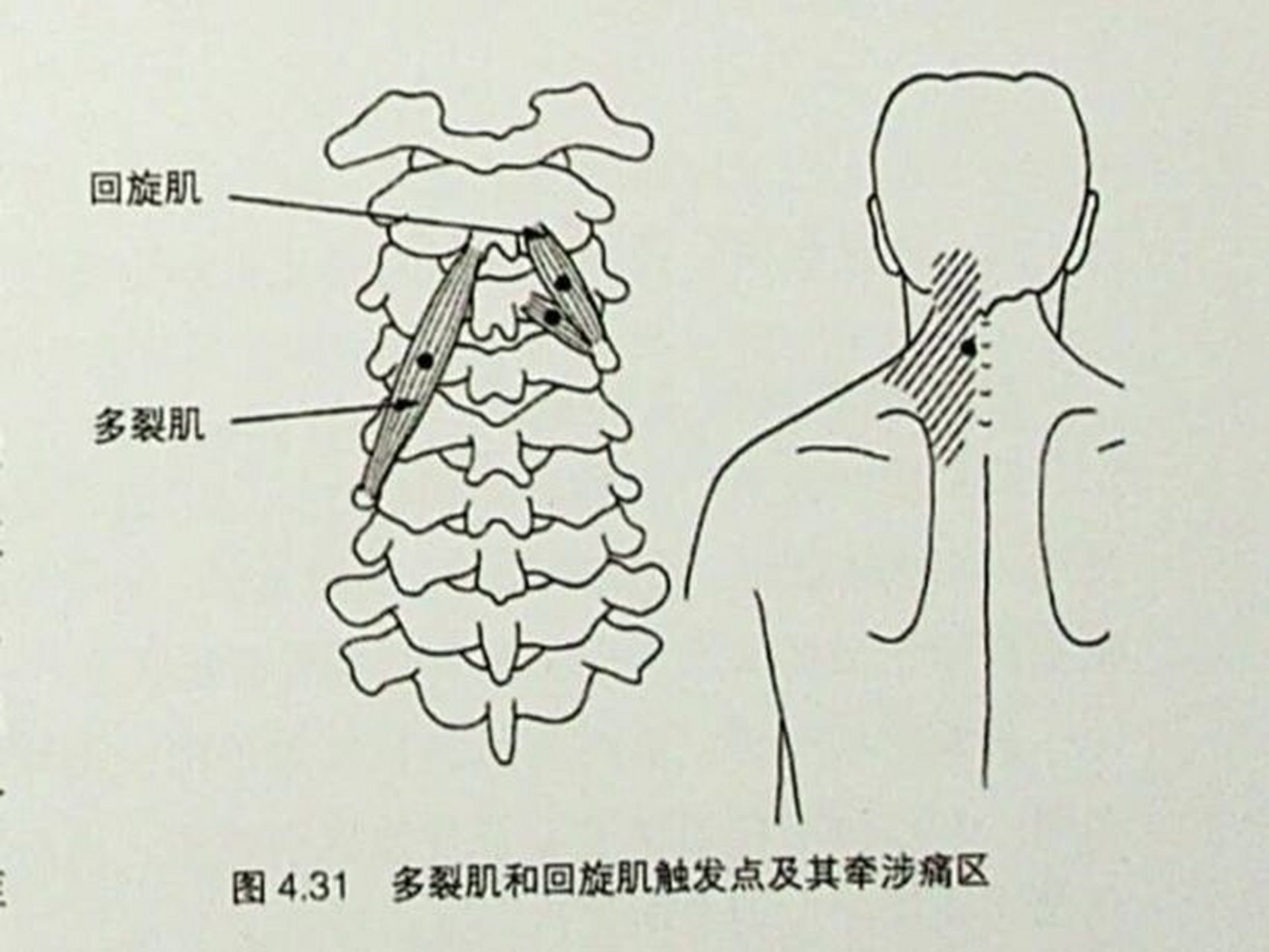 颈后肌群——多裂肌和回旋肌 多裂肌和回旋肌是颈部肌肉中位置比较深