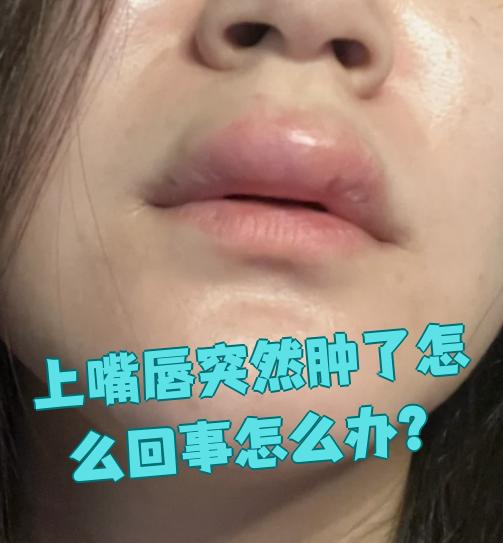 嘴唇为什么会肿