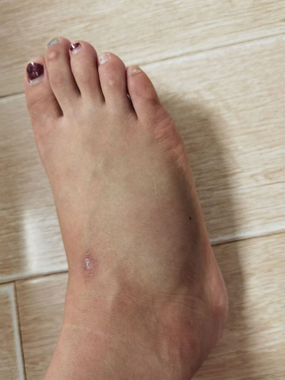 右脚第五跖骨基地骨折第四天,在家带支具,没有打石膏,打石膏太遭罪了