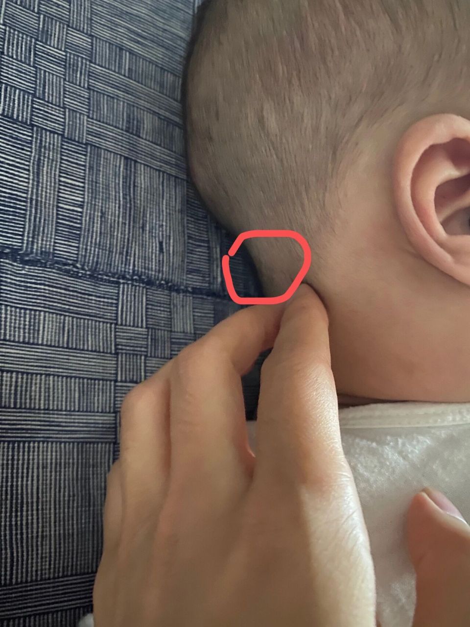 宝宝这个位置 长了个小疙瘩 今天发现后脑勺下边有一个小疙瘩,(原来没