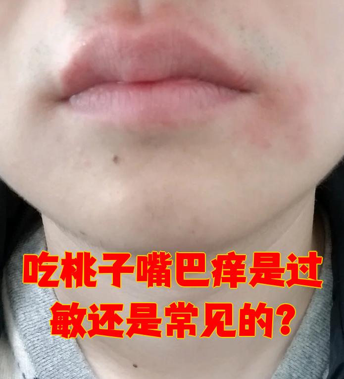 吃桃子嘴巴痒是过敏还是常见的?