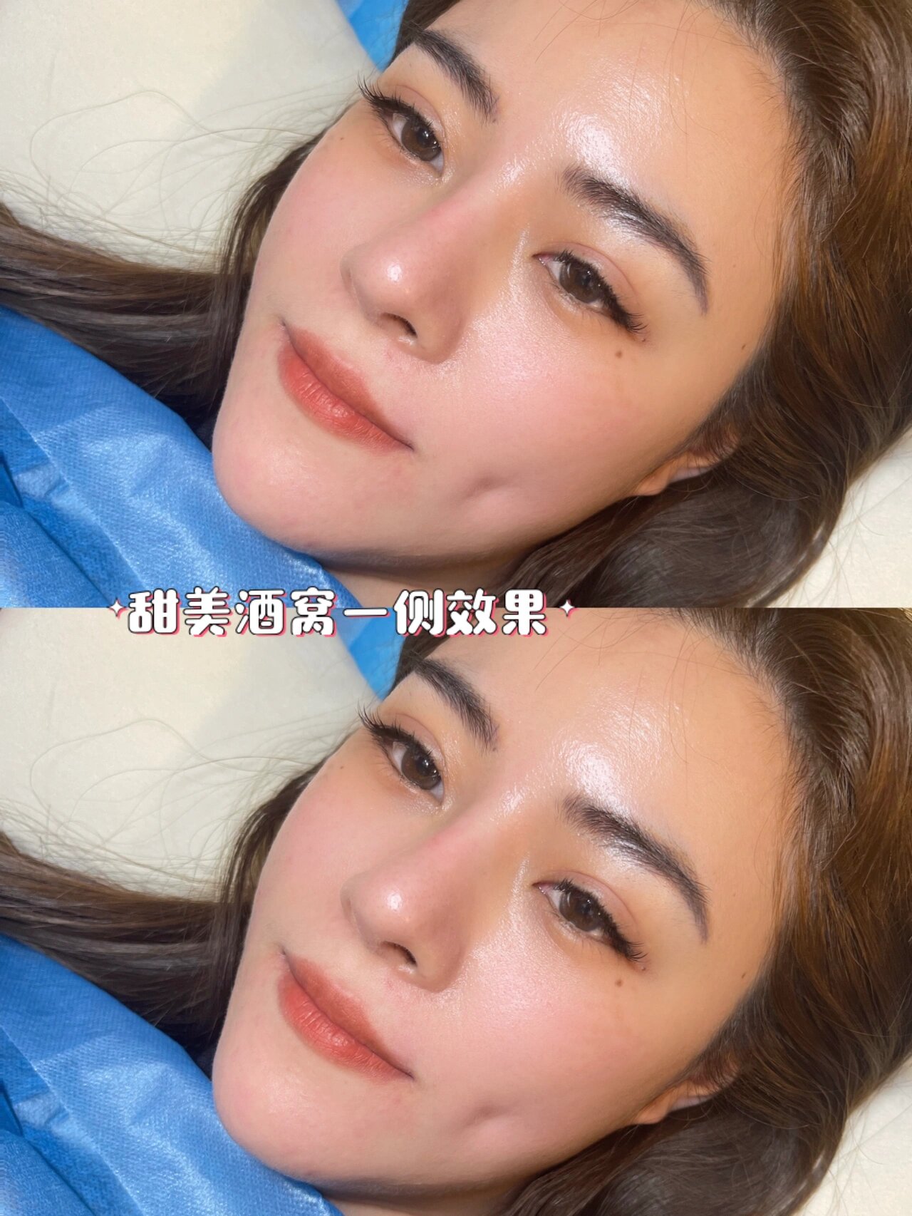 给大家讲解一下什么是酒窝形成术
