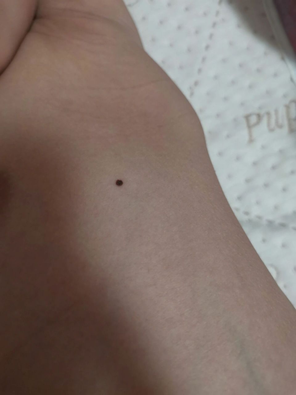 宝宝腋下这个痣要紧吗 一直都有,有点凸出,最近发现好像变黑了大了些