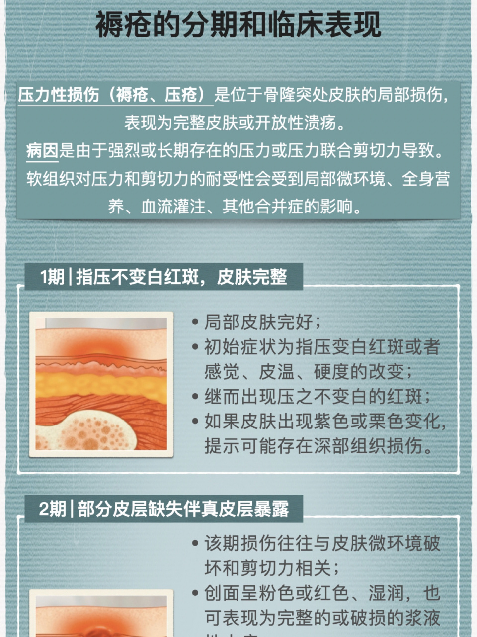 褥疮的分期和临床表现