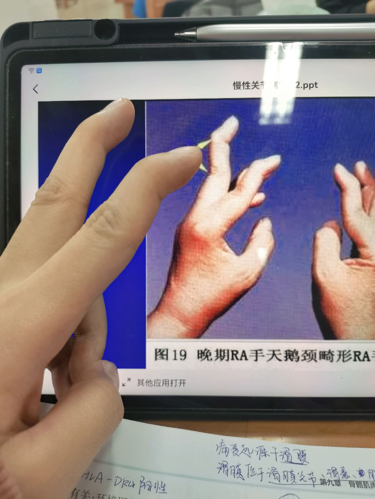 天鹅颈畸形 没病(ra)但也会 揍嘛呀这是