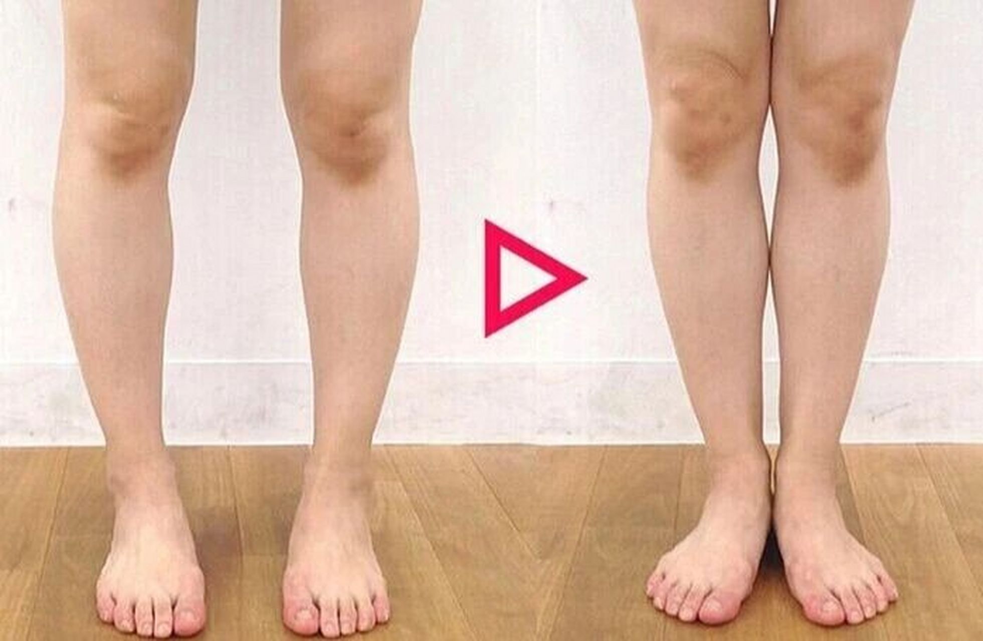 o型腿不ok(上) ——o型腿 俗称:"罗圈腿","弓形腿" ,足站立时,腿朝前