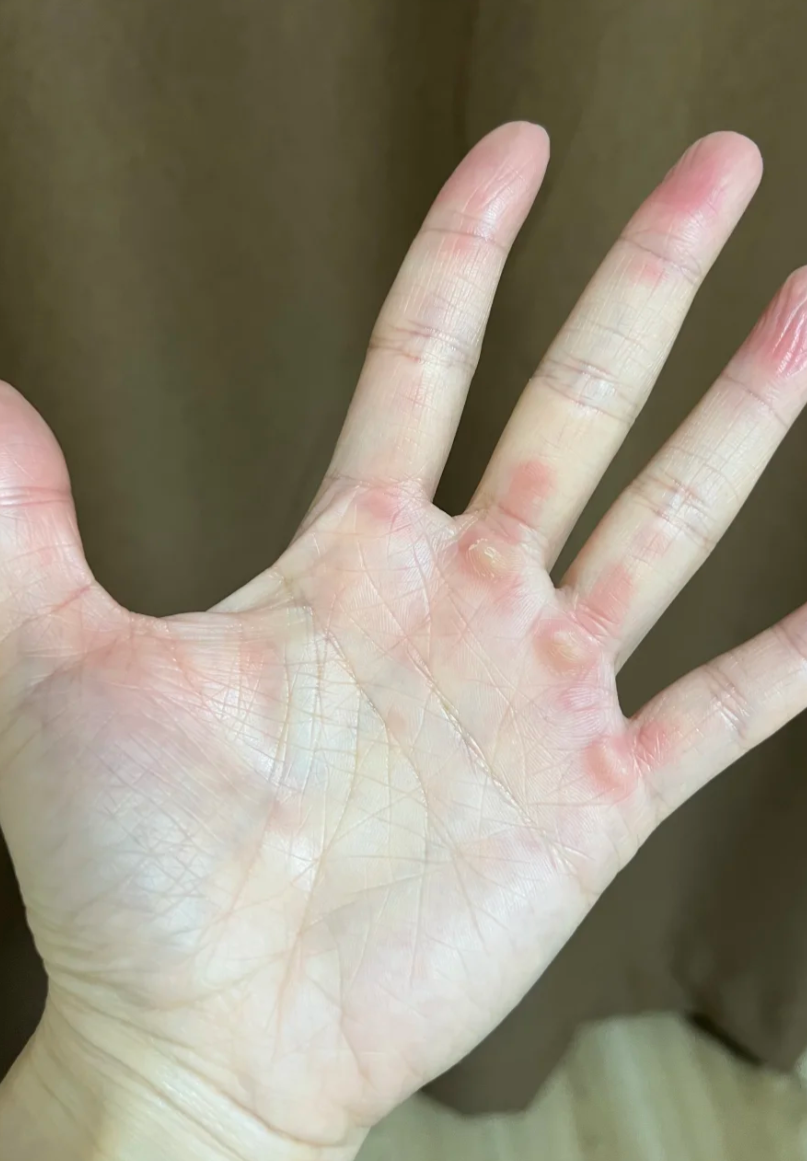 打羽毛球时手上起茧子的位置通常在手指根部,手心或指尖